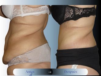 Dermolipectomía antes y después - 880983