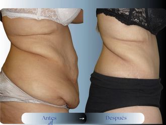 Dermolipectomía antes y después - 880984