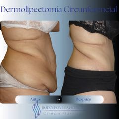 Dermolipectomia - Dr Rodolfo Villavecencio