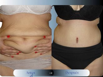 Dermolipectomía antes y después - 880985