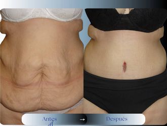 Dermolipectomía antes y después - 880986