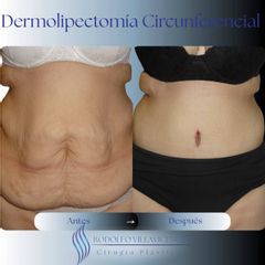 Dermolipectomia - Dr. Rodolfo Villavicencio