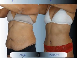 Abdominoplastía antes y después - 881047