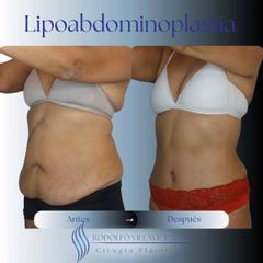 Lipoabdominoplastia - Dr. Rodolfo Villavicencio