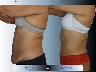 Abdominoplastía antes y después - 881048