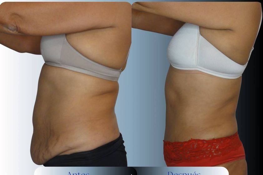 Abdominoplastía antes y después - 881048