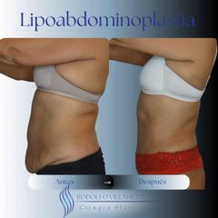 Lipoabdominoplastia - Dr. Rodolfo Villavicencio
