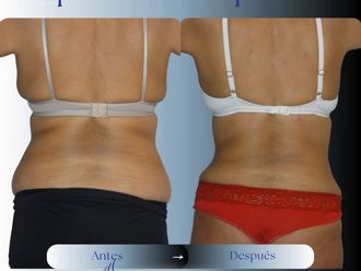 Liposucción antes y después - 881049