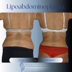 Lipoabdominoplastia - Dr. Rodolfo Villavicencio