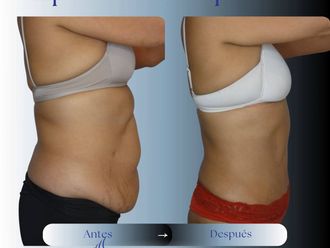 Abdominoplastía antes y después - 881050