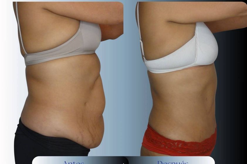 Abdominoplastía antes y después - 881050