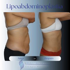 Lipoabdominoplastia - Dr. Rodolfo Villavicencio