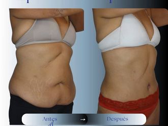 Liposucción antes y después - 881051