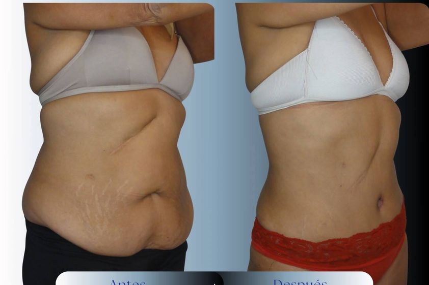 Liposucción antes y después - 881051
