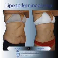 Lipoabdominoplastia - Dr. Rodolfo Villavicencio
