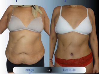 Liposucción antes y después - 881052