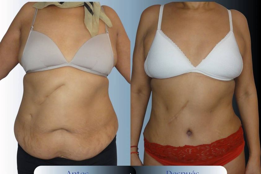 Liposucción antes y después - 881052