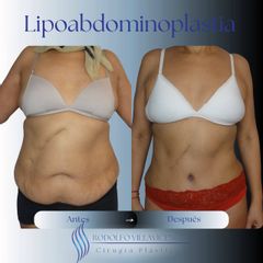 Lipoabdominoplatia - Dr. Rodolfo Villavicencio