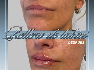 Relleno de labios antes y después - 881126