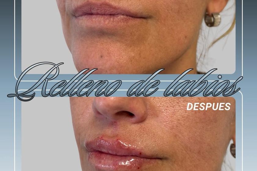 Relleno de labios antes y después - 881126