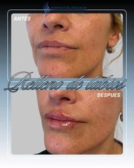 Rellenos de Labios - Dr. Rodolfo Villavicencio