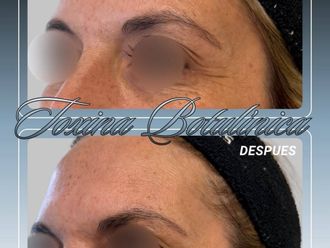 Botox antes y después - 881160