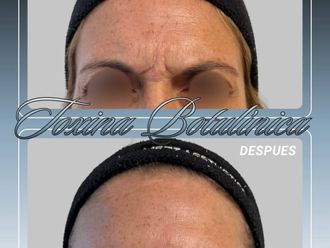 Botox antes y después - 881161