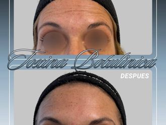 Botox antes y después - 881162