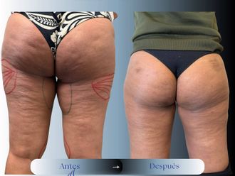 Liposucción antes y después - 881182