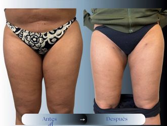 Liposucción antes y después - 881183