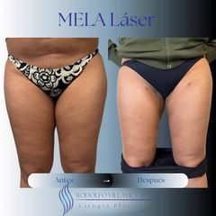 Mela - Dr. Rodolfo Villavicencio