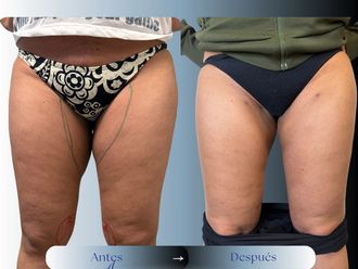 Liposucción antes y después - 881184
