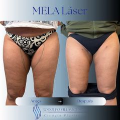 Mela - Dr. Rodolfo Villavicencio