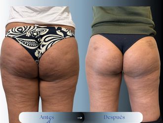 Liposucción antes y después - 881185
