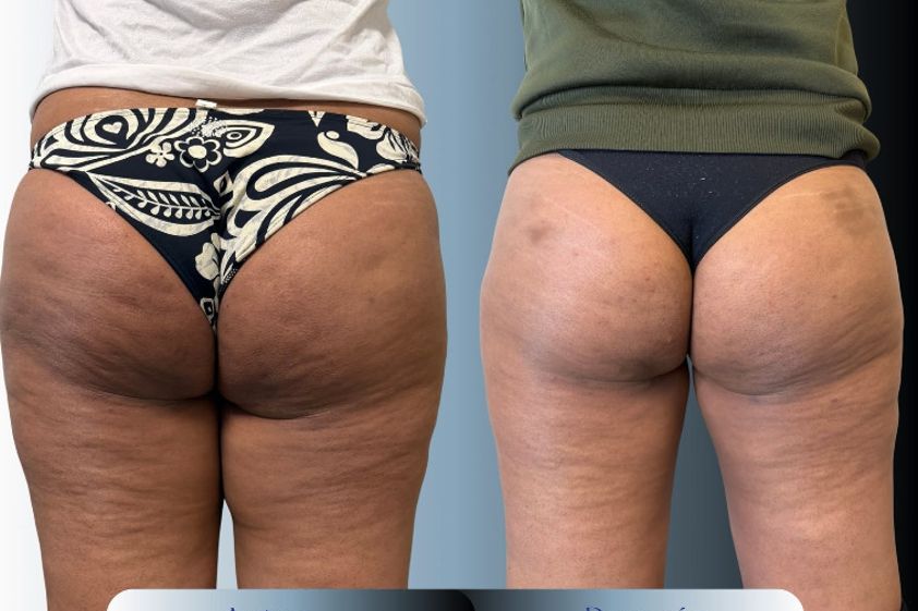 Liposucción antes y después - 881185