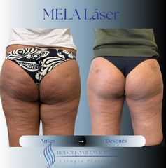 Mela - Dr. Rodolfo Villavicencio