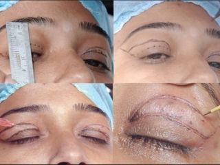 Blefaroplastia