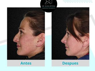 Rinoplastia - 844619