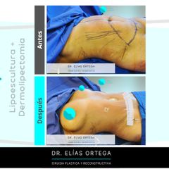 Abdominoplastia - Dr. Elias Ortega