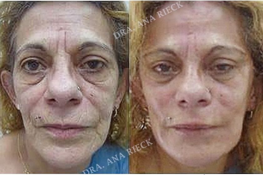 Rellenos faciales antes y después - 624011