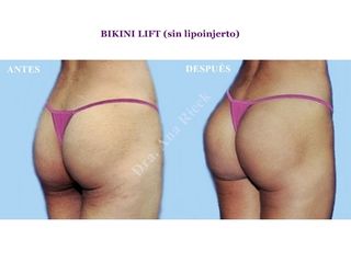 Bikini lift