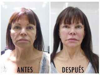 Lifting con células madre FAMI (Facial Autograft Muscle Injection)- Rieck Klinik Medic