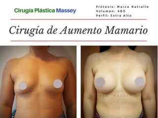 Cirugía de Aumento Mamario