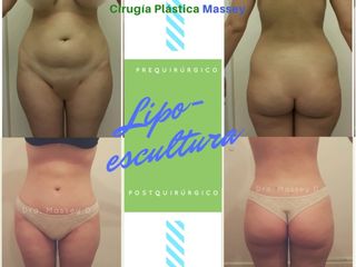 Lipoescultura Laser de Alta Definición