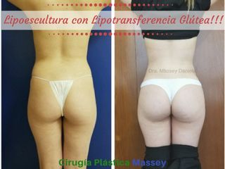 Lipoescultura con Lipotransferencia Glútea