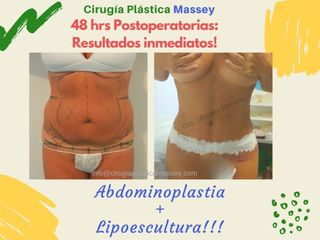 Abdominoplastia con Lipoescultura Abdominal