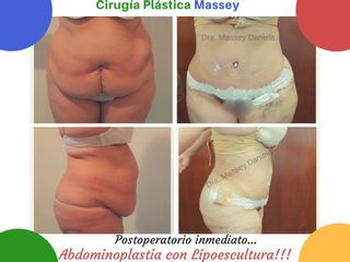 Abdominoplastia con Lipoescultura Abdominal