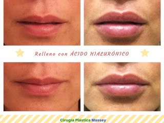 Relleno labios con Ácido Hialurónico