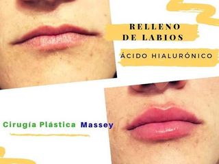 Relleno labios con Ácido Hialurónico