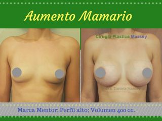 Cirugía de Aumento Mamario